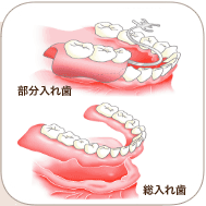 入れ歯とは？