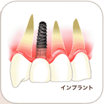 インプラントとは?